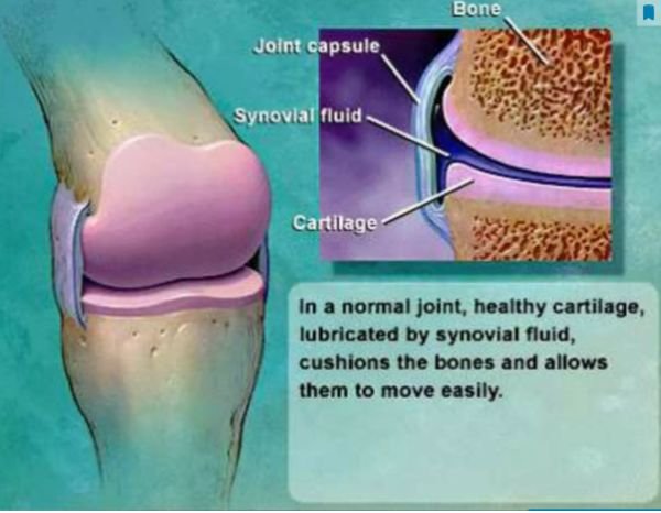 What Is Knee Osteoarthritis