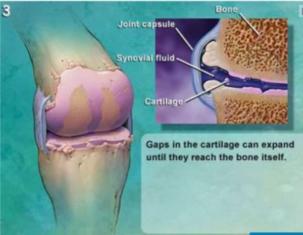 Knee Osteoarthritis