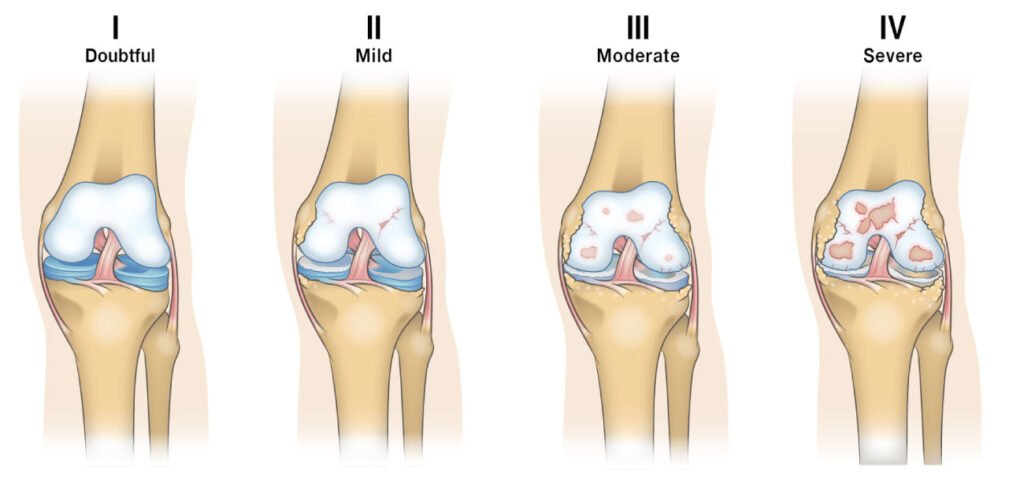 Kellgren-Lawrence-Stages-of-Knee-Osteoarthritis-1024x479